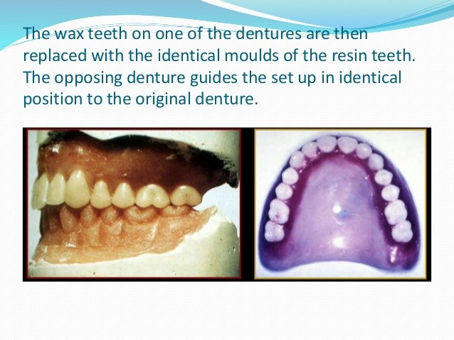 Eating With Partial Dentures Burns WY 82053